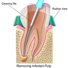 RootCanal