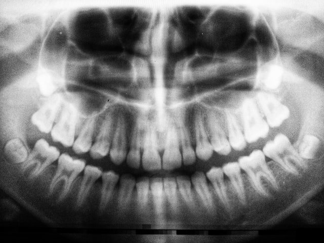 teeth x-ray